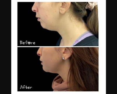 Chin Implant Before & After Gallery - Patient 304145 - Image 3