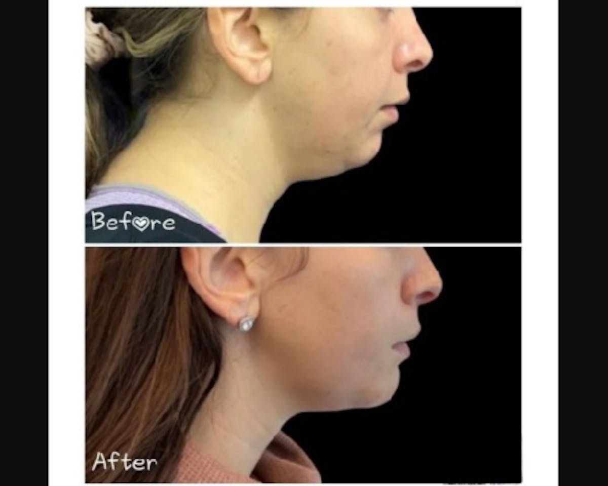 Chin Implant Before & After Gallery - Patient 304145 - Image 2