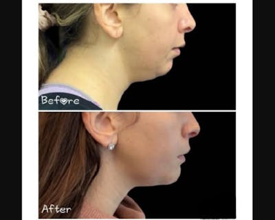 Chin Implant Before & After Gallery - Patient 304145 - Image 2