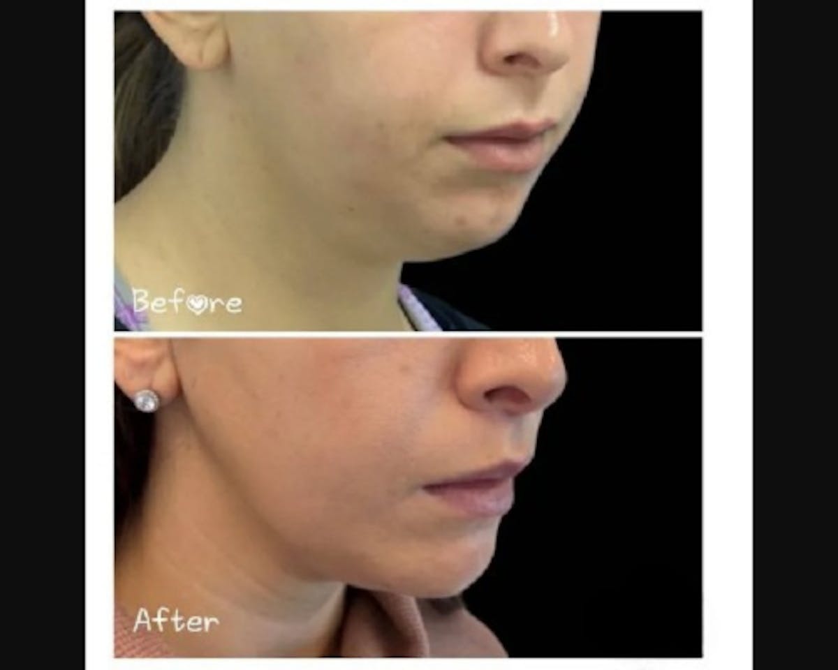 Chin Implant Before & After Gallery - Patient 304145 - Image 1