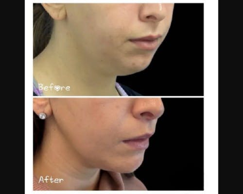 Chin Implant Before & After Gallery - Patient 304145 - Image 1