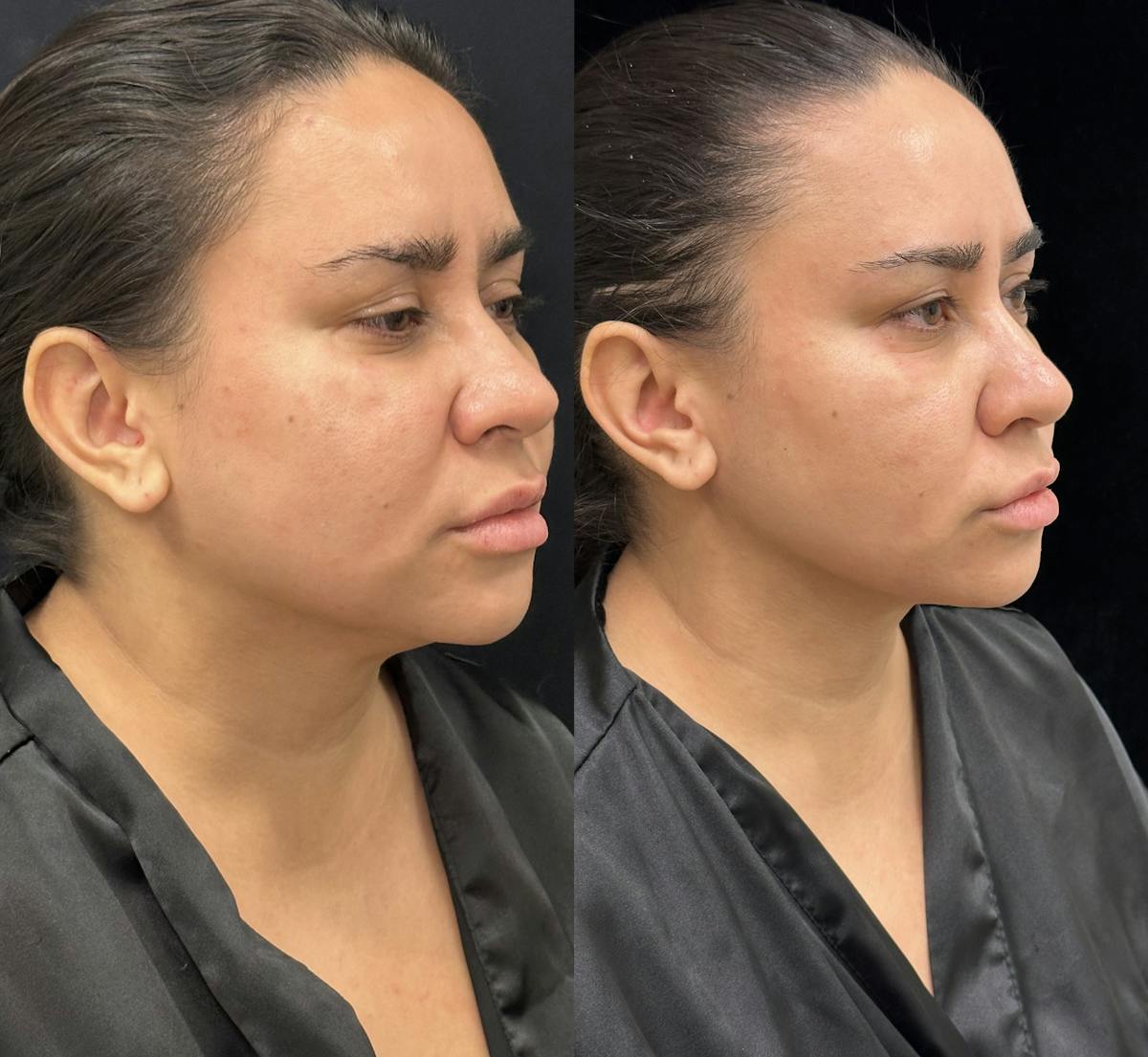 Chin & Neck Lipo Sculpting Before & After Gallery - Patient 307527 - Image 2