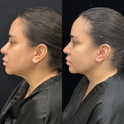 Chin & Neck Lipo Sculpting Before & After Gallery - Patient 307527 - Image 3