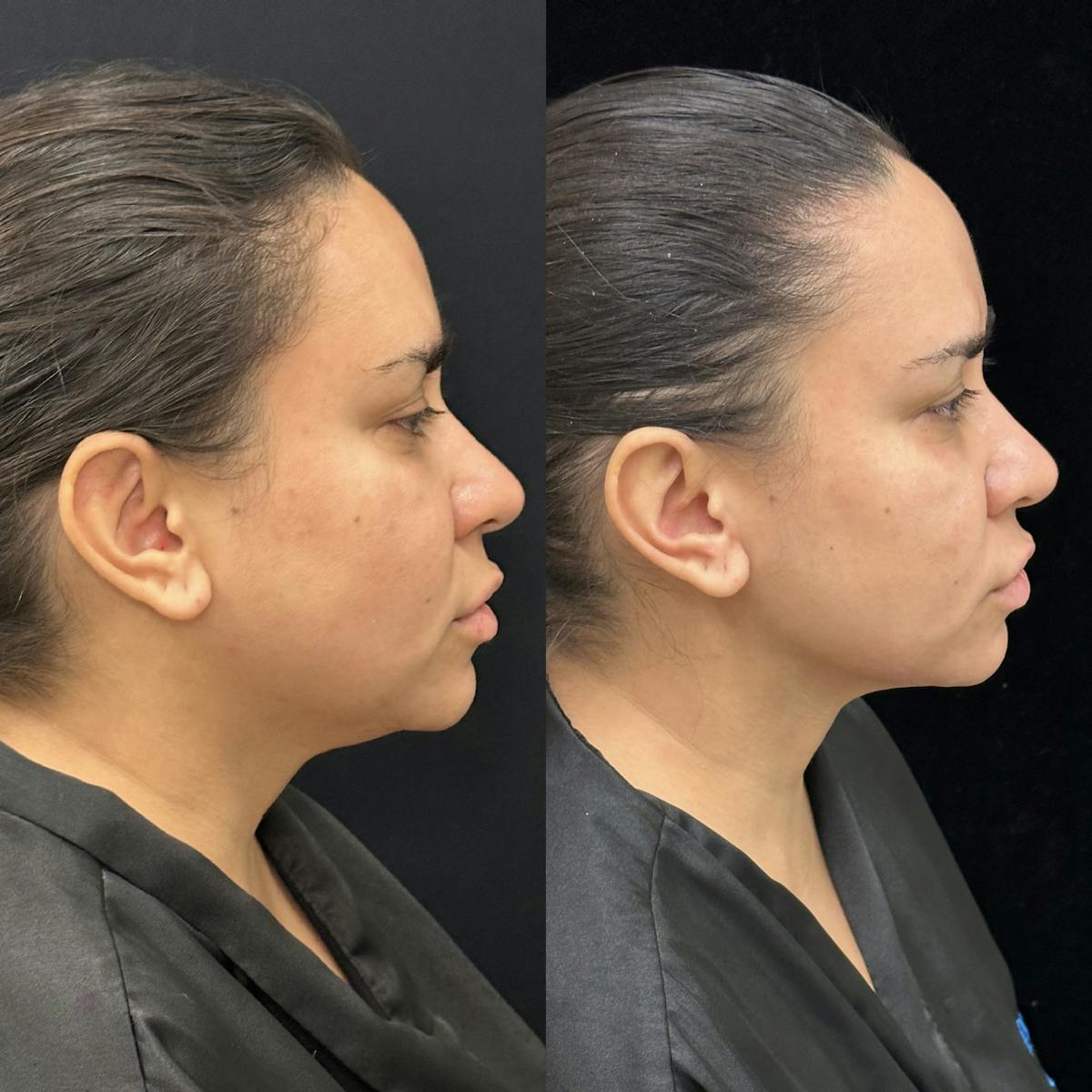 Chin & Neck Lipo Sculpting Before & After Gallery - Patient 307527 - Image 1