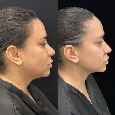 Chin & Neck Lipo Sculpting Before & After Gallery - Patient 307527 - Image 1