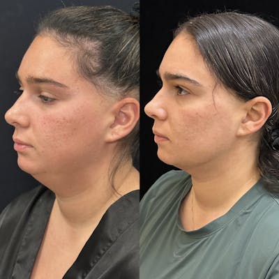 Chin & Neck Lipo Sculpting Before & After Gallery - Patient 219241 - Image 3
