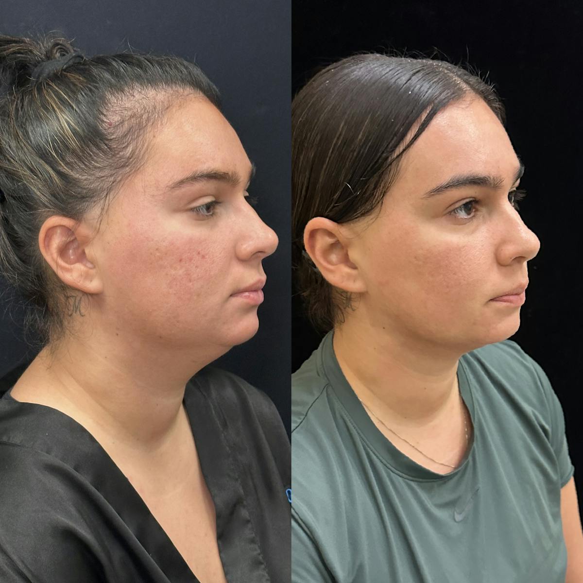 Chin & Neck Lipo Sculpting Before & After Gallery - Patient 219241 - Image 2