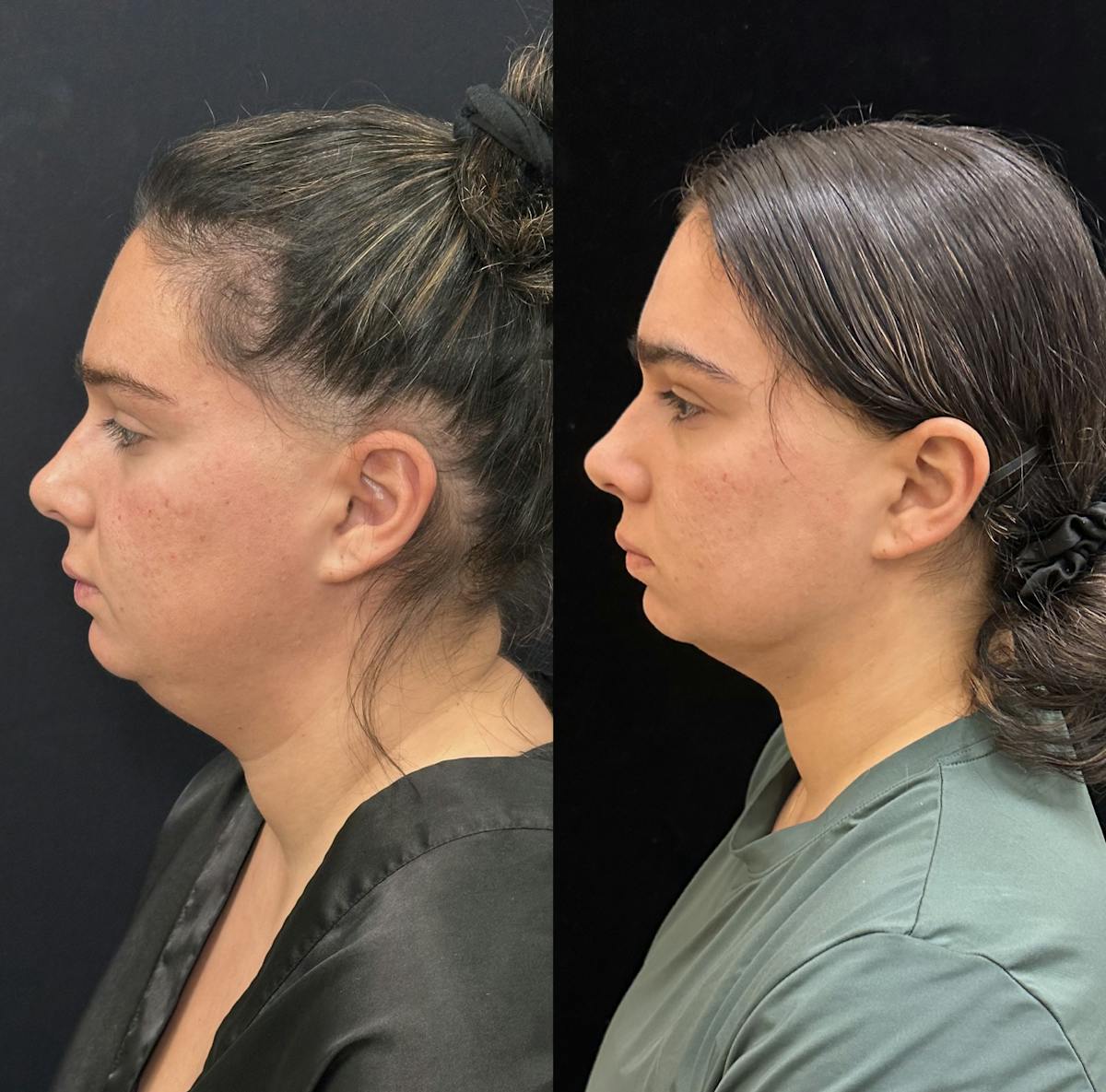 Chin & Neck Lipo Sculpting Before & After Gallery - Patient 219241 - Image 4