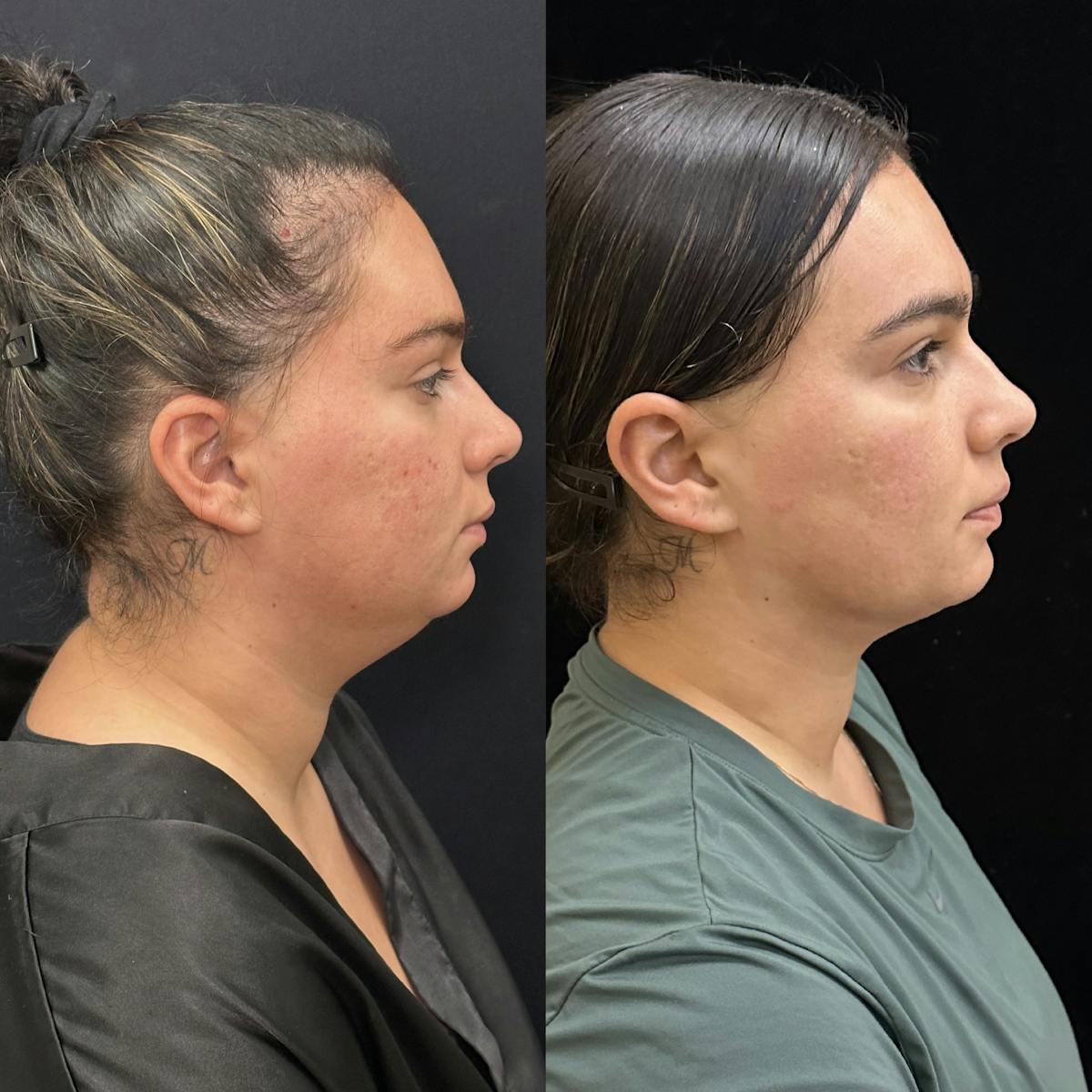Chin & Neck Lipo Sculpting Before & After Gallery - Patient 219241 - Image 1