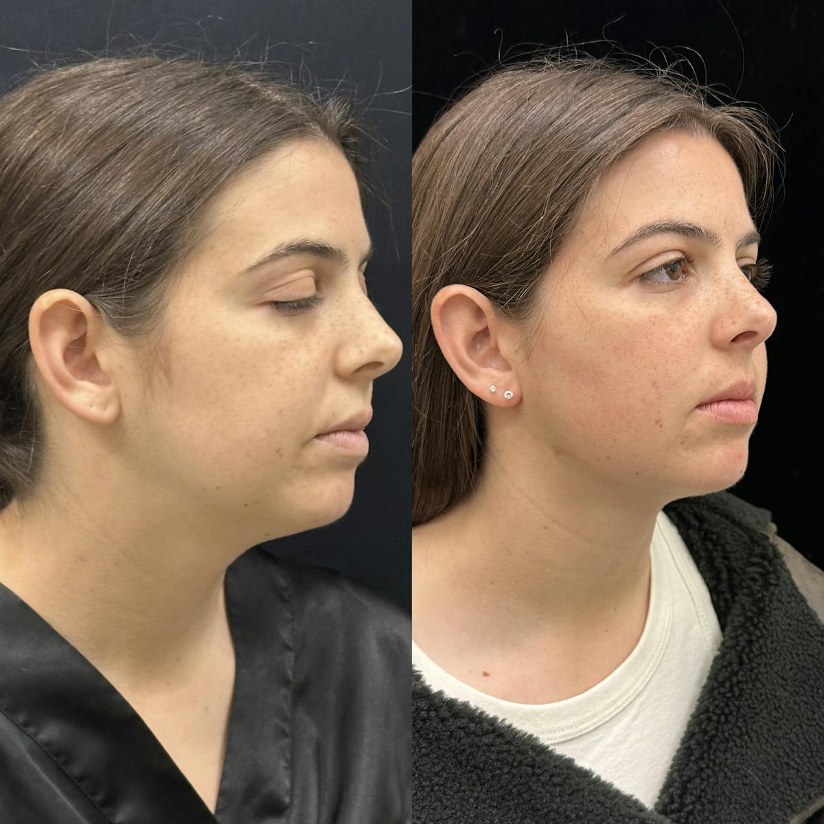 Chin & Neck Lipo Sculpting Before & After Gallery - Patient 124724 - Image 2