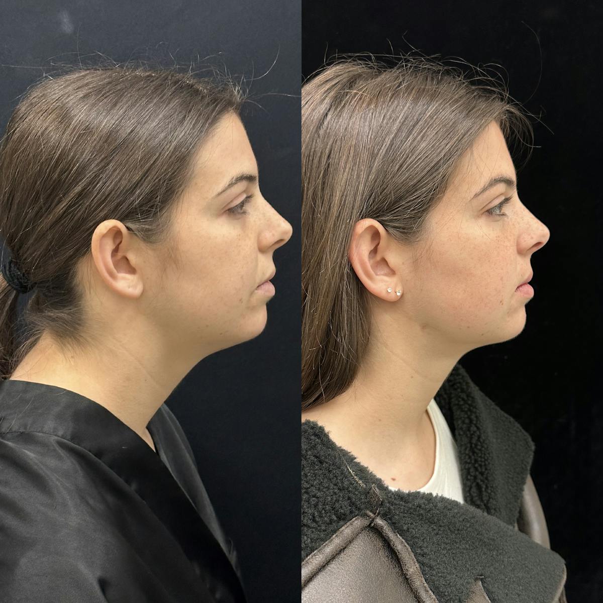 Chin & Neck Lipo Sculpting Before & After Gallery - Patient 124724 - Image 1