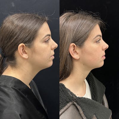 Chin & Neck Lipo Sculpting Before & After Gallery - Patient 124724 - Image 1