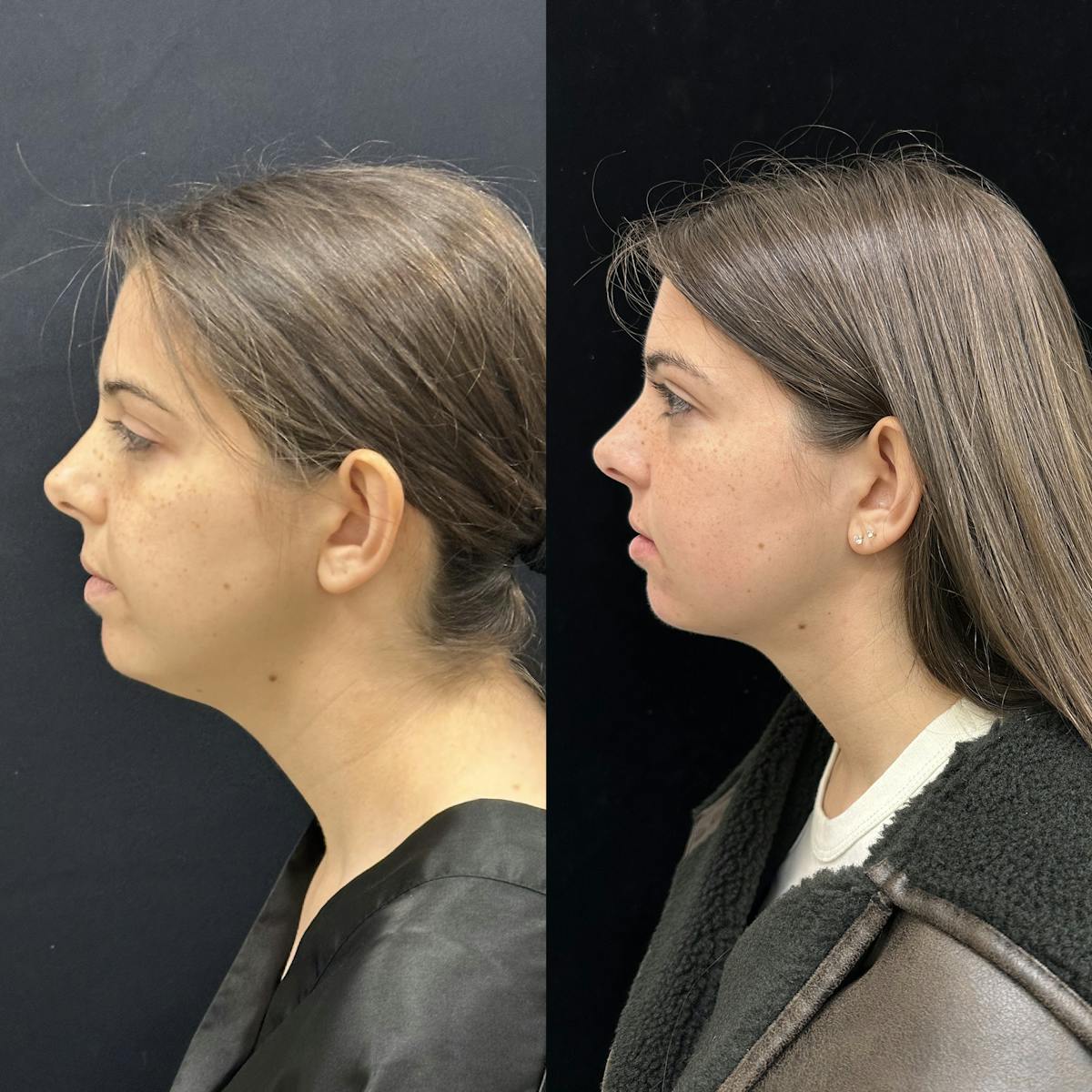 Chin & Neck Lipo Sculpting Before & After Gallery - Patient 124724 - Image 4