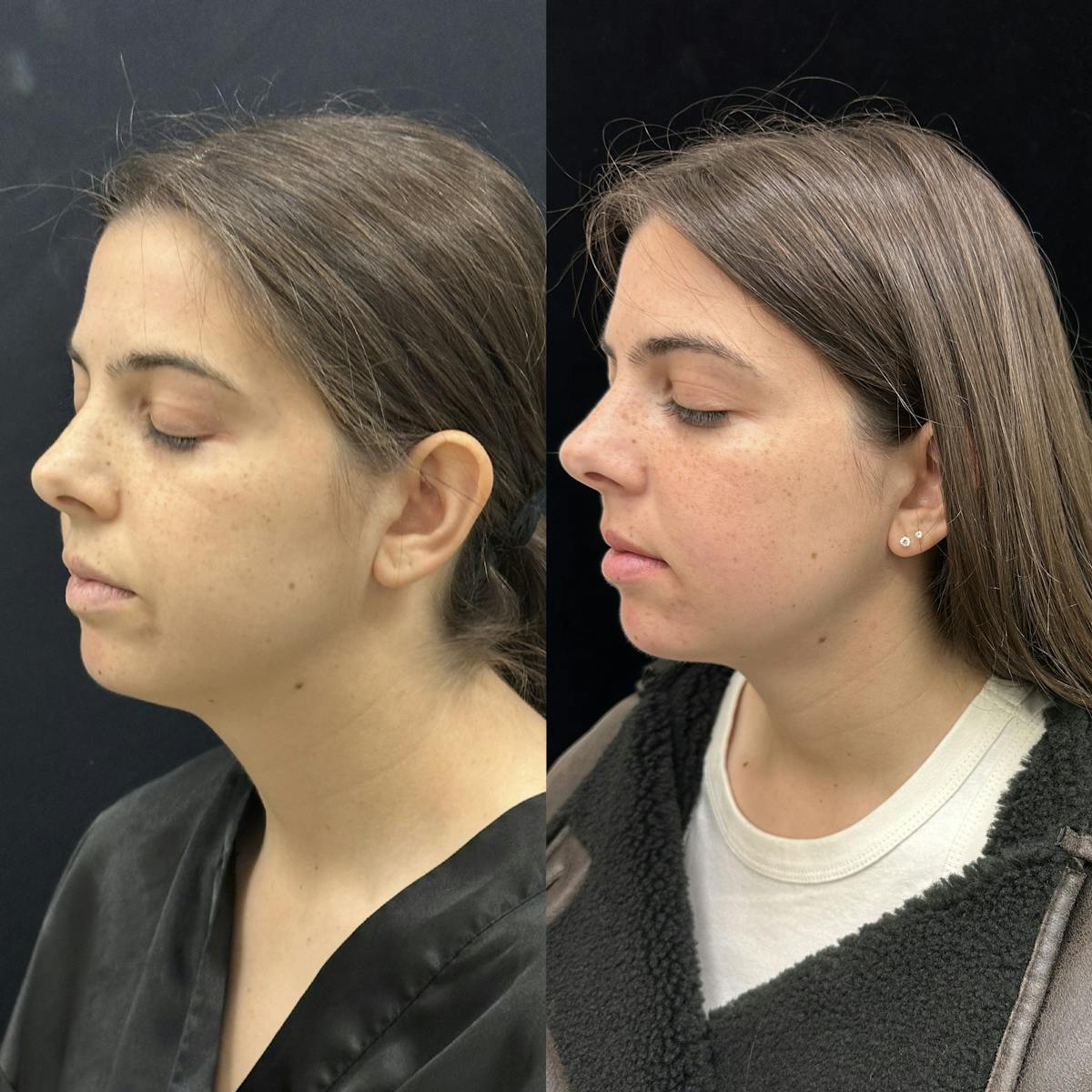 Chin & Neck Lipo Sculpting Before & After Gallery - Patient 124724 - Image 3