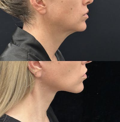 Deep Plane Facelift Before & After Gallery - Patient 303625 - Image 1