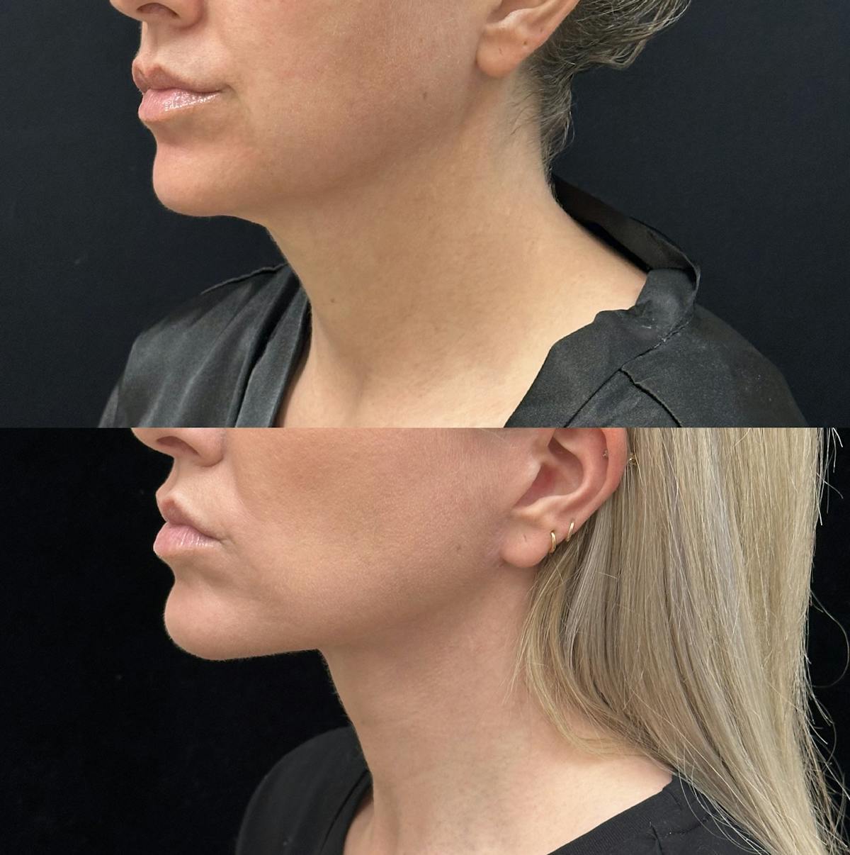 Deep Plane Facelift Before & After Gallery - Patient 303625 - Image 5
