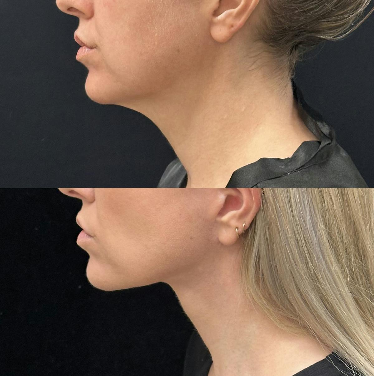 Deep Plane Facelift Before & After Gallery - Patient 303625 - Image 4