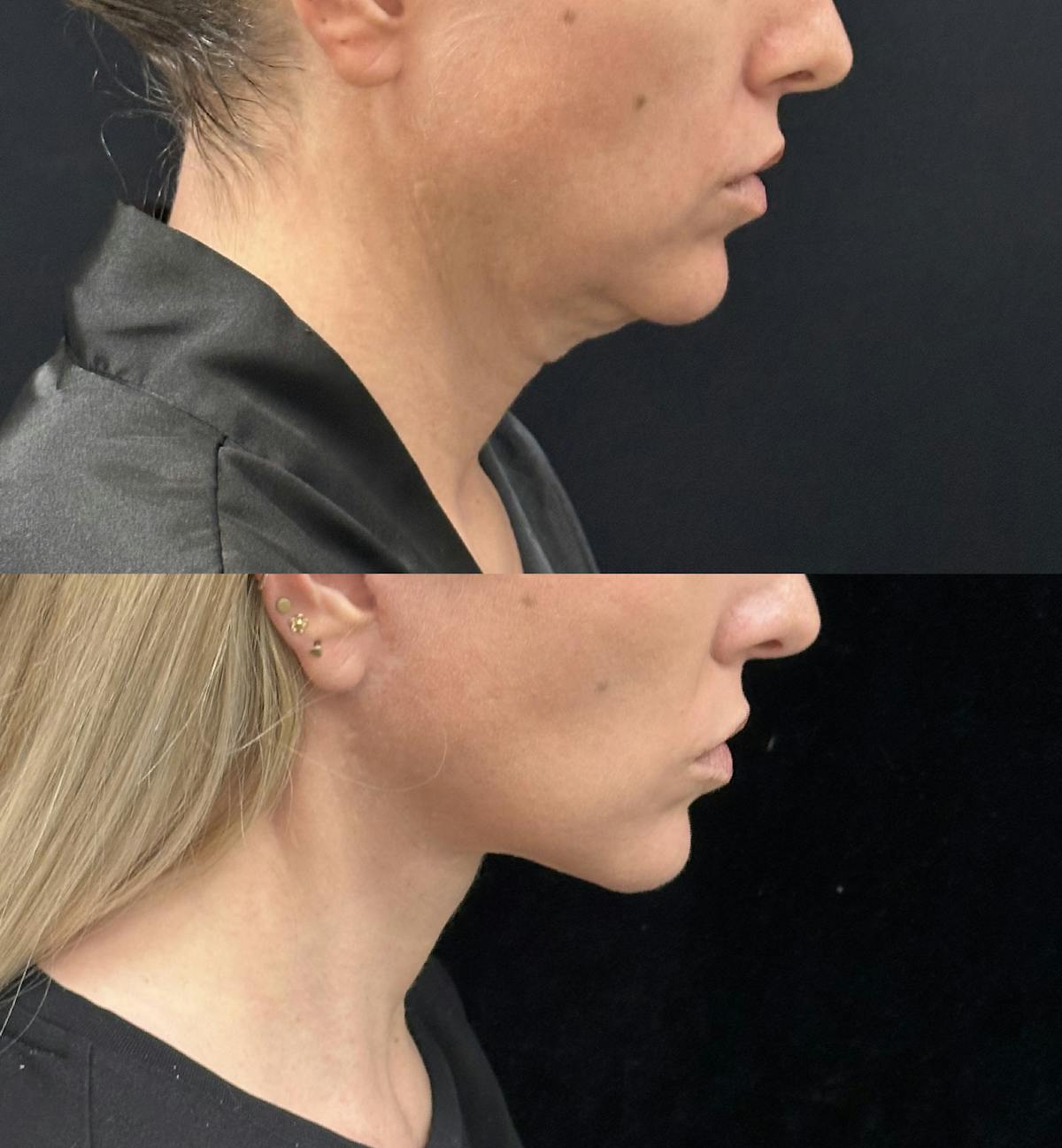 Deep Plane Facelift Before & After Gallery - Patient 303625 - Image 3