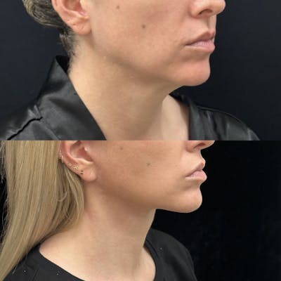 Deep Plane Facelift Before & After Gallery - Patient 303625 - Image 2