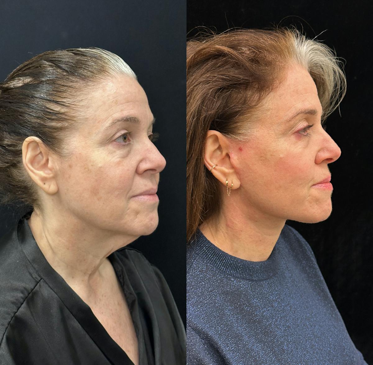 Deep Plane Facelift Before & After Gallery - Patient 134591 - Image 2