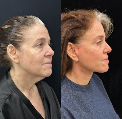 Deep Plane Facelift Before & After Gallery - Patient 134591 - Image 2