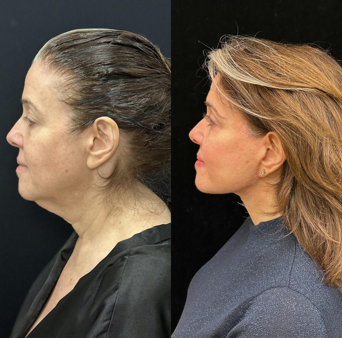 Deep Plane Facelift Before & After Gallery - Patient 134591 - Image 4