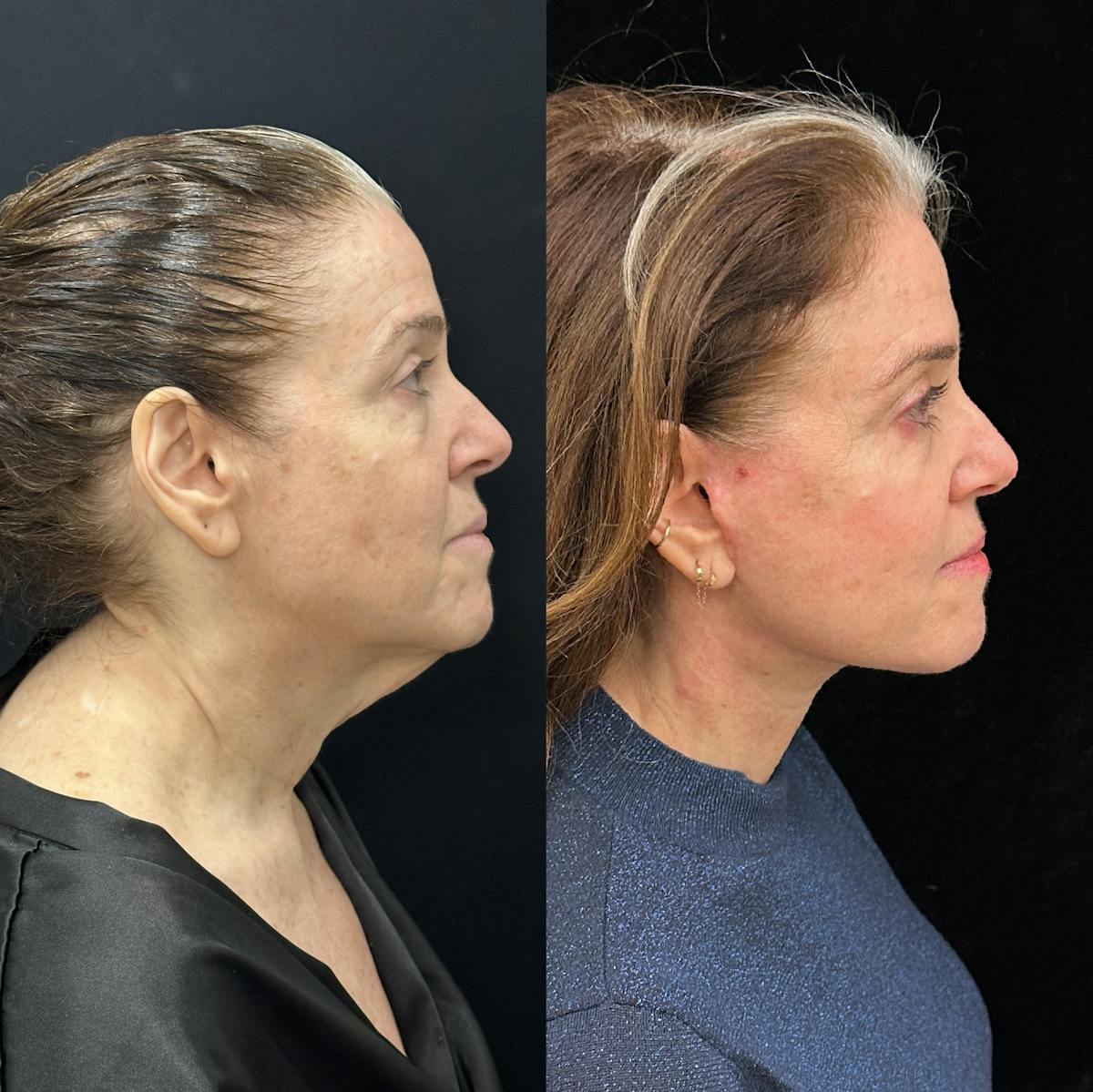 Deep Plane Facelift Before & After Gallery - Patient 134591 - Image 1