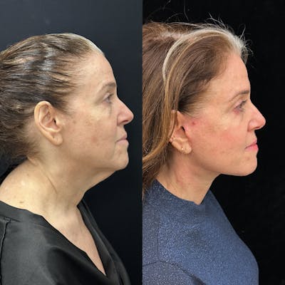 Deep Plane Facelift Before & After Gallery - Patient 134591 - Image 1
