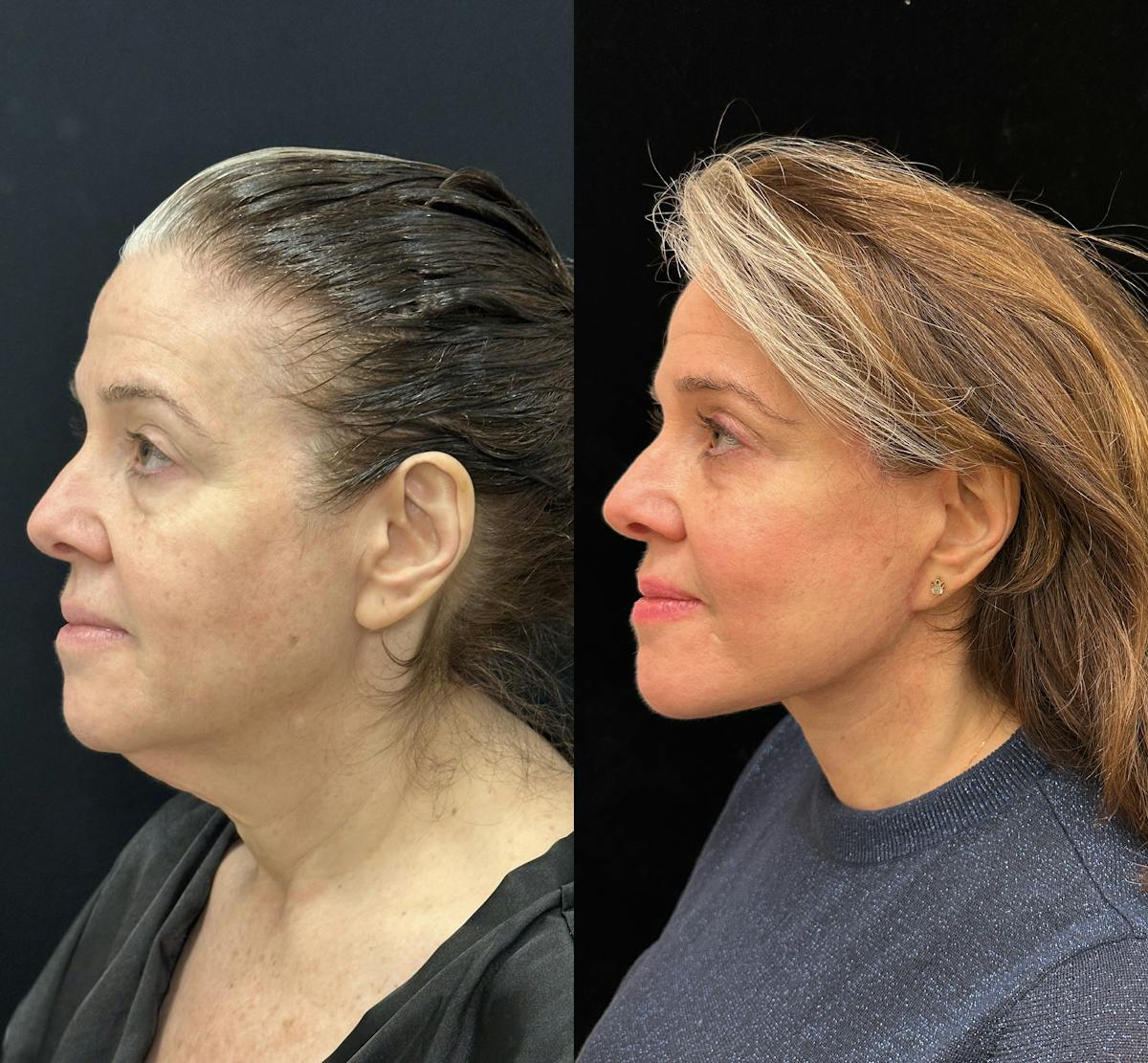 Deep Plane Facelift Before & After Gallery - Patient 134591 - Image 3