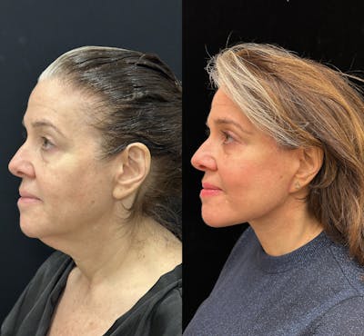 Deep Plane Facelift Before & After Gallery - Patient 134591 - Image 3
