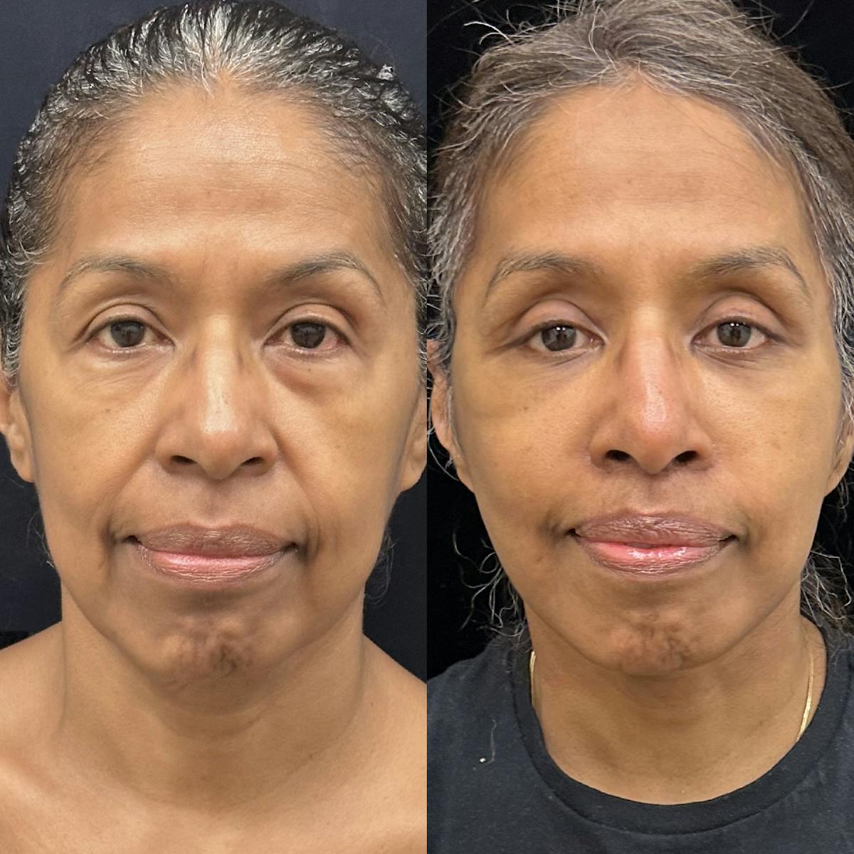 Deep Plane Facelift Before & After Gallery - Patient 331414 - Image 3
