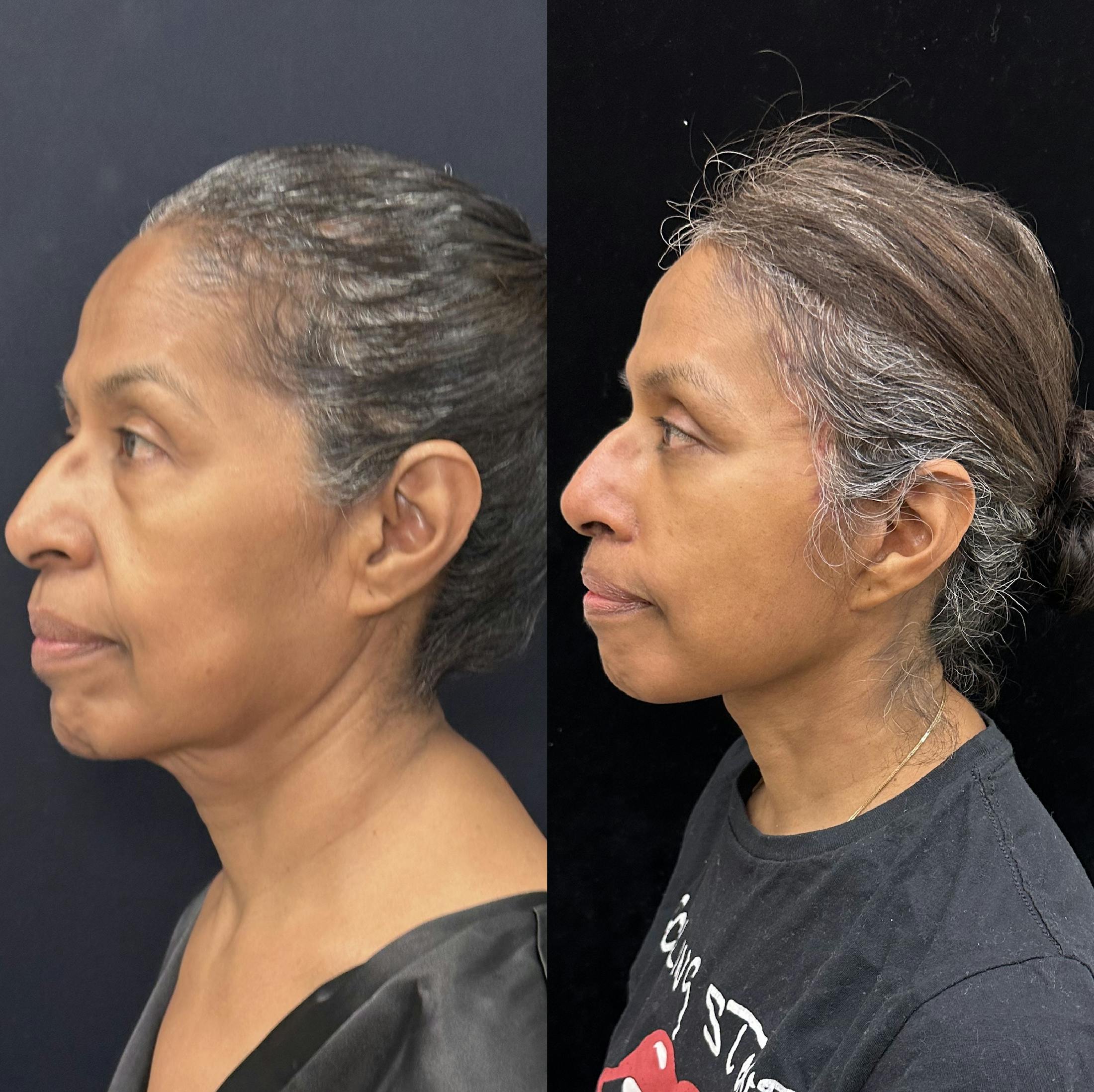 Deep Plane Facelift Before & After Gallery - Patient 331414 - Image 5