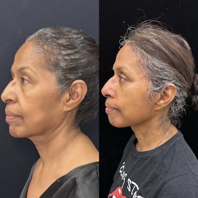 Deep Plane Facelift Before & After Gallery - Patient 331414 - Image 5