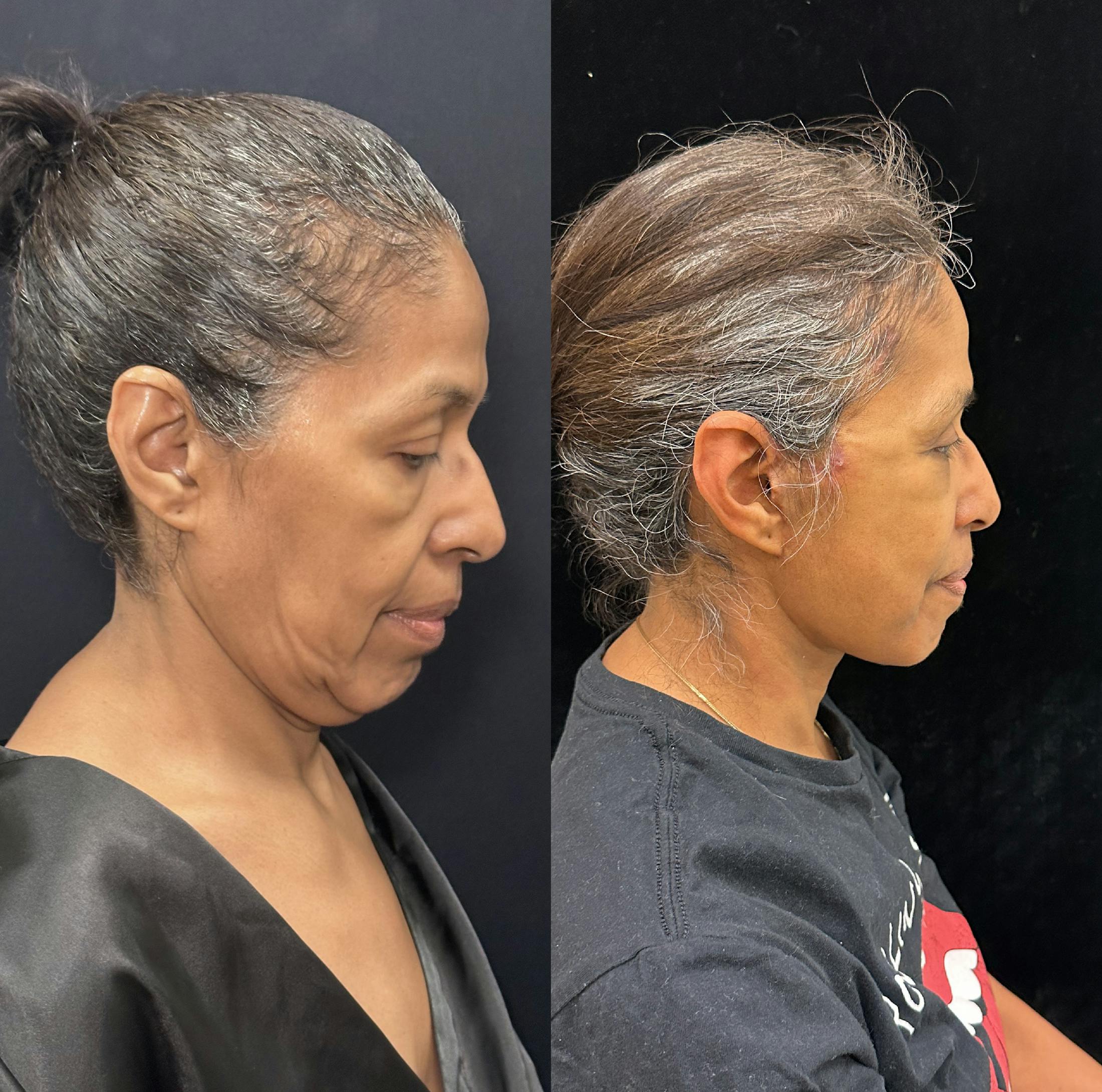 Deep Plane Facelift Before & After Gallery - Patient 331414 - Image 2