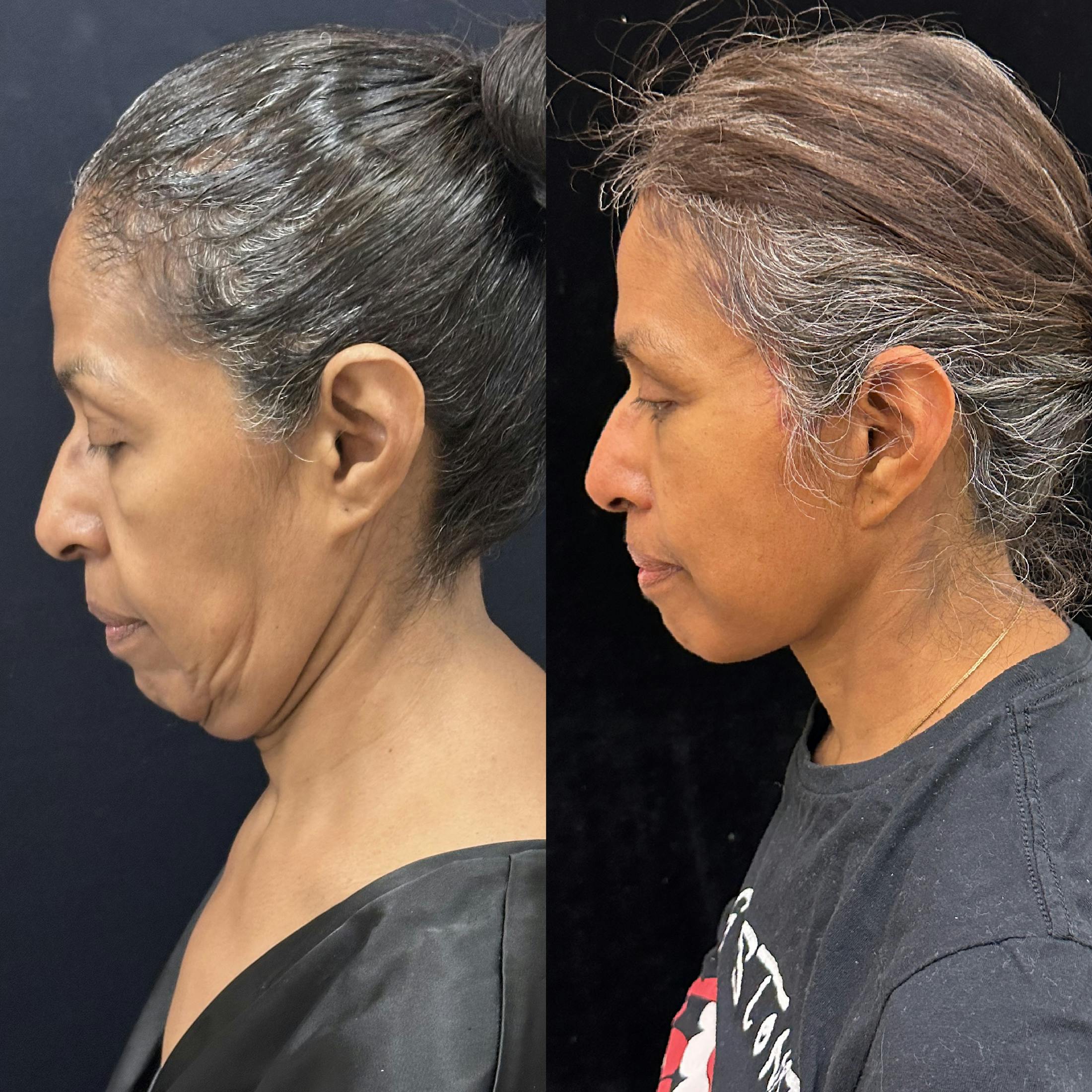 Deep Plane Facelift Before & After Gallery - Patient 331414 - Image 4