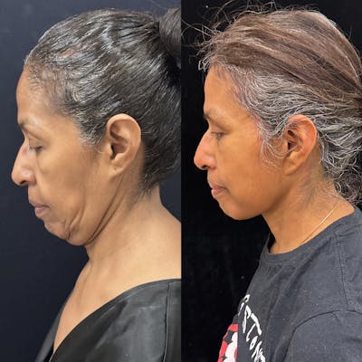 Deep Plane Facelift Before & After Gallery - Patient 331414 - Image 4