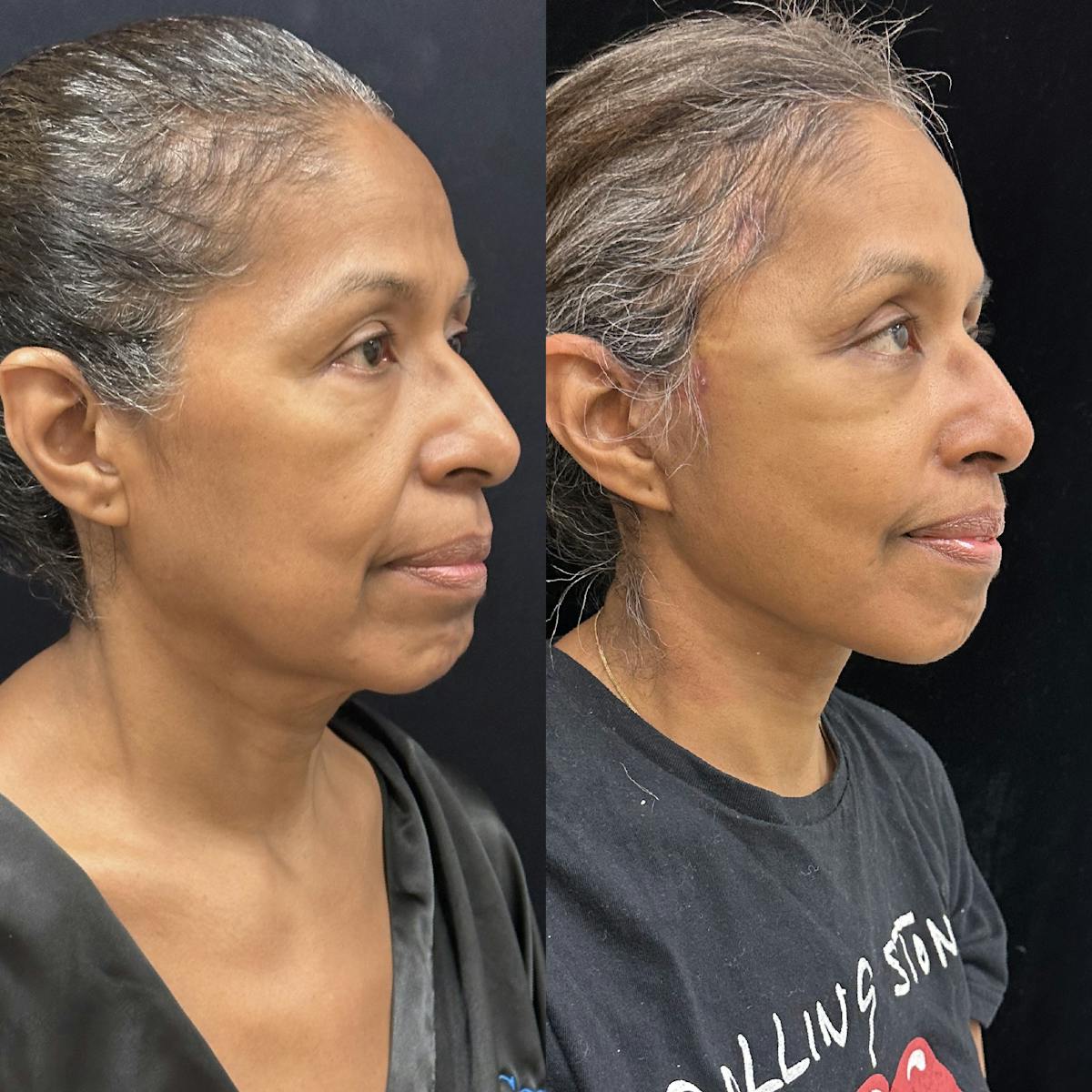 Deep Plane Facelift Before & After Gallery - Patient 331414 - Image 1