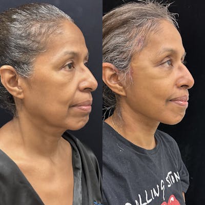 Deep Plane Facelift Before & After Gallery - Patient 331414 - Image 1