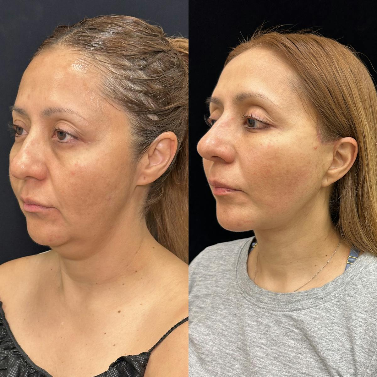 Deep Plane Facelift Before & After Gallery - Patient 293467 - Image 3