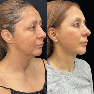 Deep Plane Facelift Before & After Gallery - Patient 293467 - Image 2