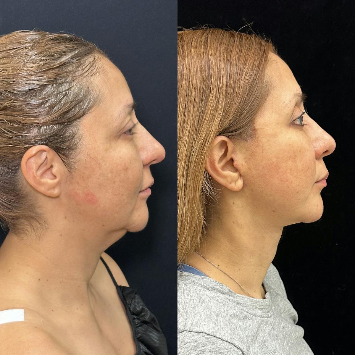 Deep Plane Facelift Before & After Gallery - Patient 293467 - Image 1