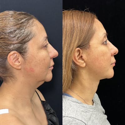 Deep Plane Facelift Before & After Gallery - Patient 293467 - Image 1