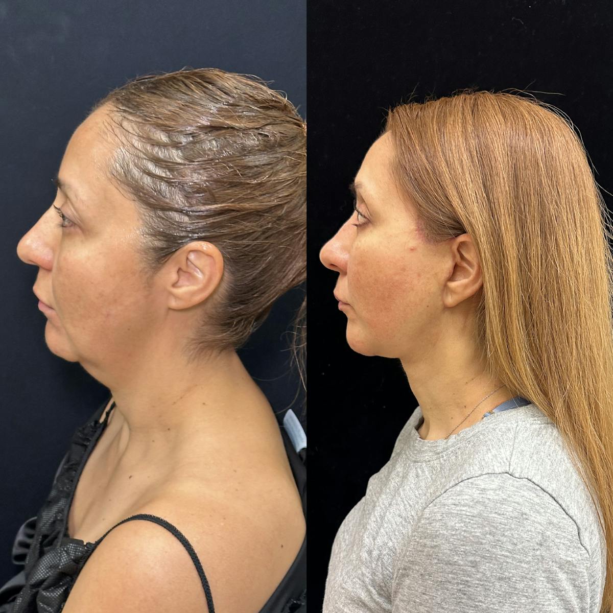 Deep Plane Facelift Before & After Gallery - Patient 293467 - Image 4
