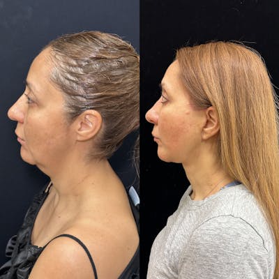 Deep Plane Facelift Before & After Gallery - Patient 293467 - Image 4