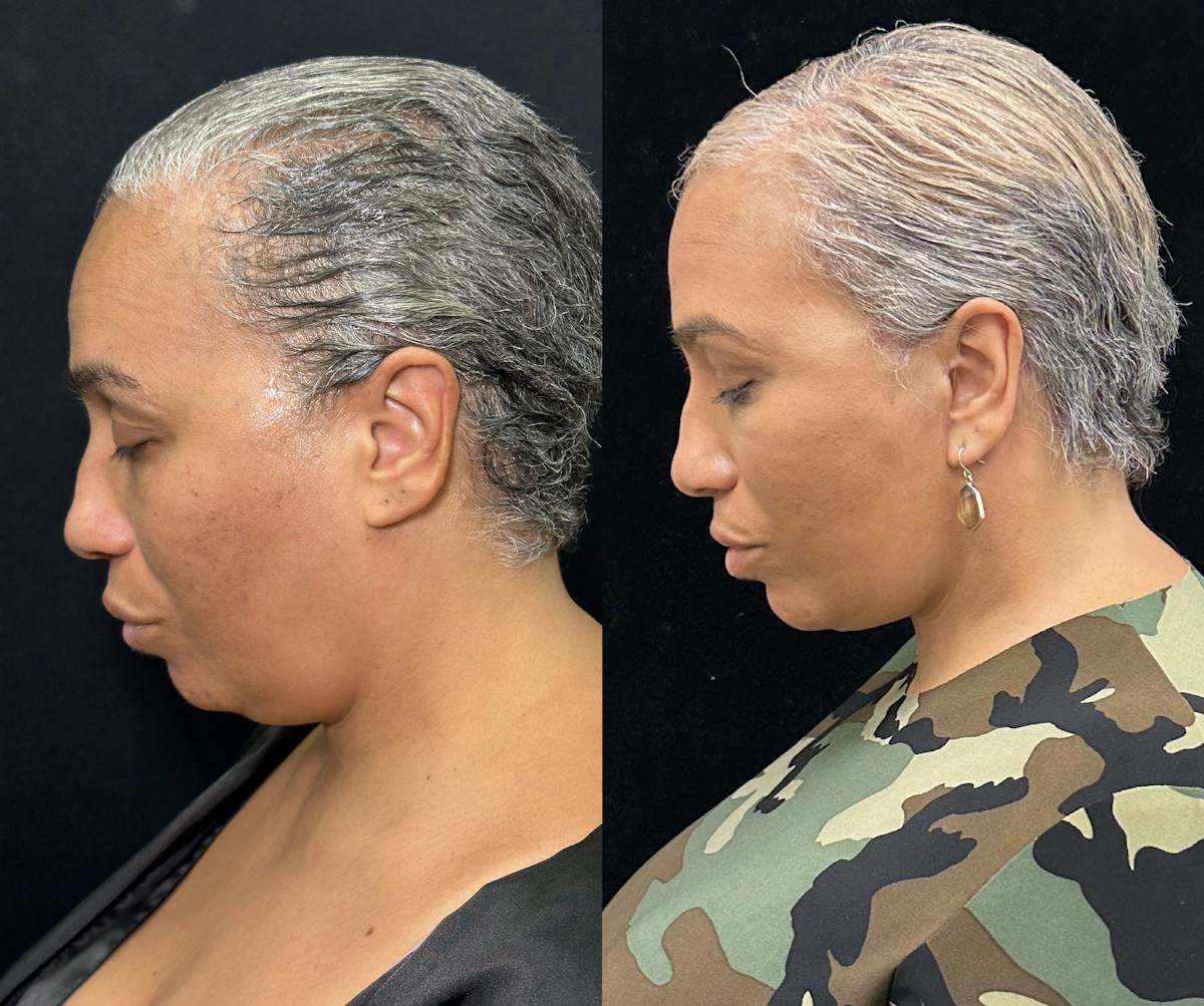 Deep Plane Facelift Before & After Gallery - Patient 117019 - Image 6