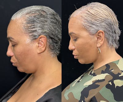 Deep Plane Facelift Before & After Gallery - Patient 117019 - Image 6