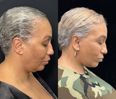 Deep Plane Facelift Before & After Gallery - Patient 117019 - Image 3