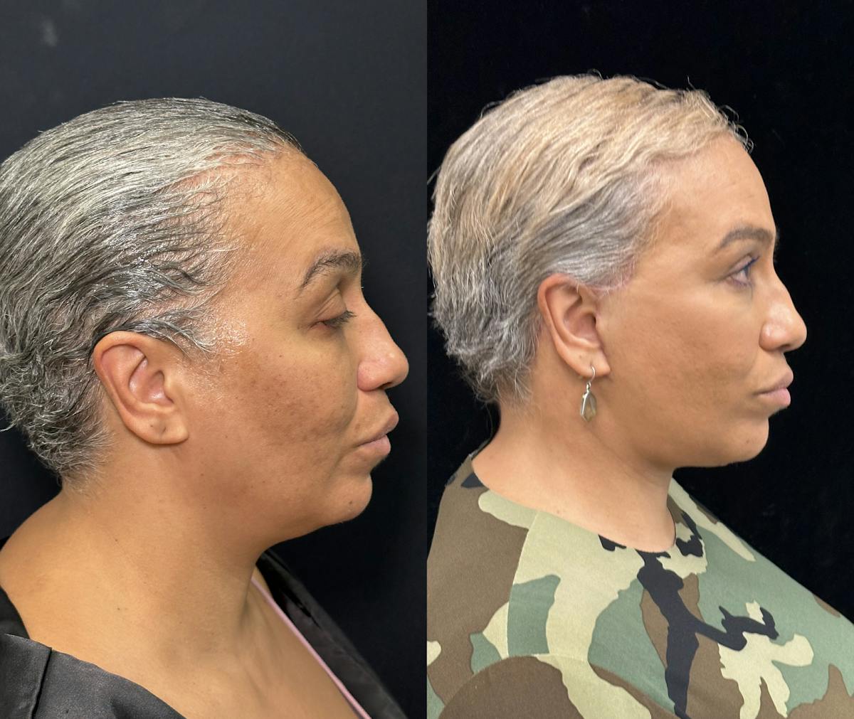 Deep Plane Facelift Before & After Gallery - Patient 117019 - Image 1