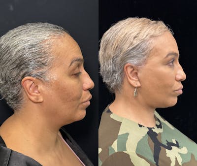 Deep Plane Facelift Before & After Gallery - Patient 117019 - Image 1