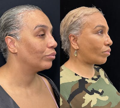 Deep Plane Facelift Before & After Gallery - Patient 117019 - Image 2